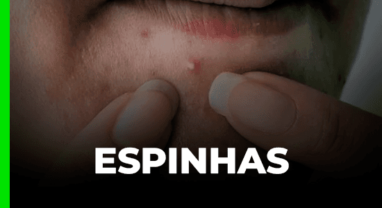 Espinhas
